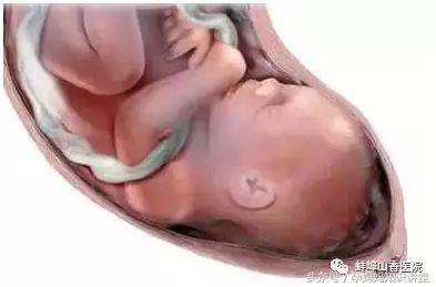 胎儿颈部绕脐两周怎么办_胎儿多少周就定型不会绕颈了_胎儿绕颈成w型严重吗